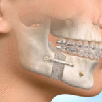 Understanding Jaw Surgery: What It Is and When It’s Needed