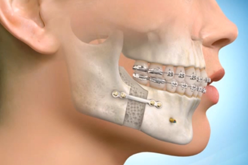 Understanding Jaw Surgery: What It Is and When It’s Needed